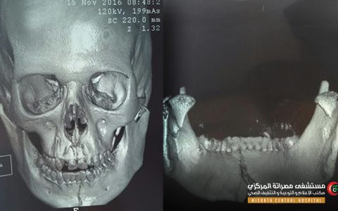 “الوجه والفكين” تثبت كسراً بالفك السفلي في 4 ساعات