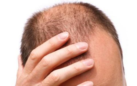 دراسة: هل يوجد علاج لتساقط الشعر أو الصلع الوراثي؟