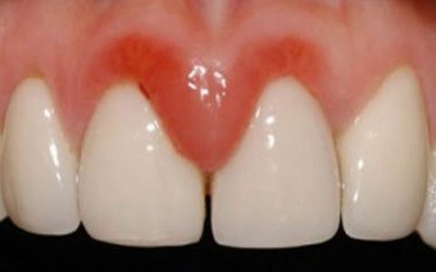 دراسة: أمراض اللثة تعزز احتمالات الإصابة بالزهايمر