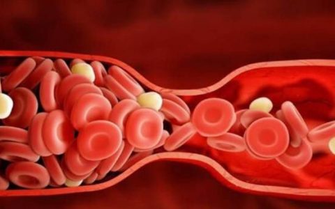 الجلطة أو الخثرة الدموية